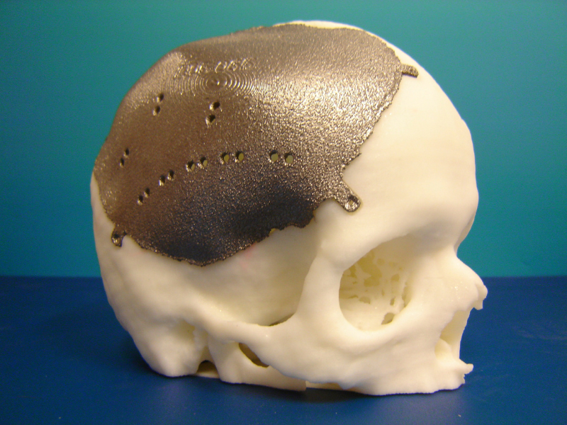 Spinal Implants and Radiolucent