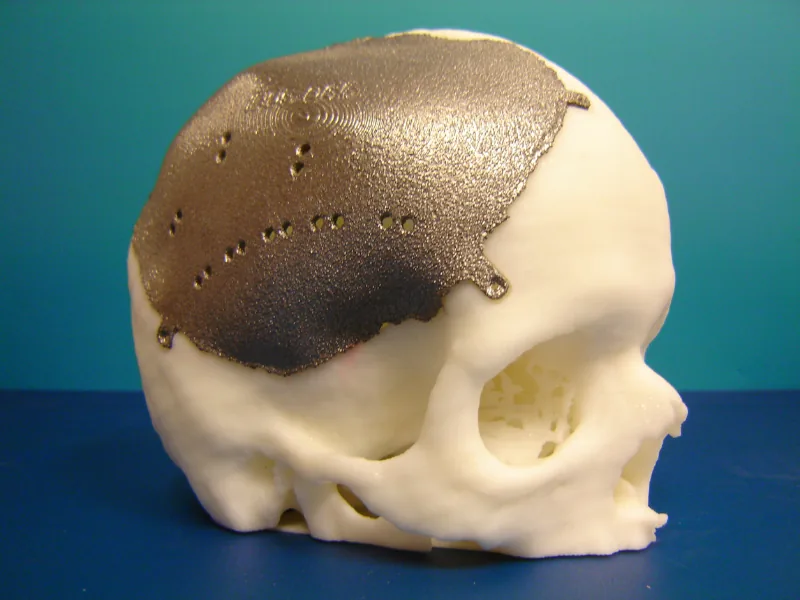 Spinal Implants and Radiolucent